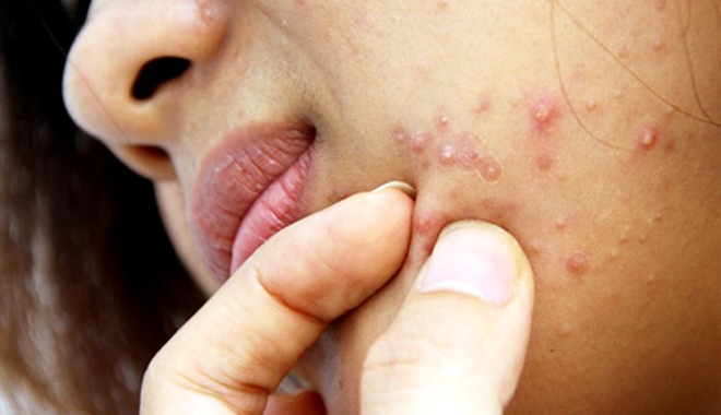 Mụn giộp - Hình ảnh minh họa